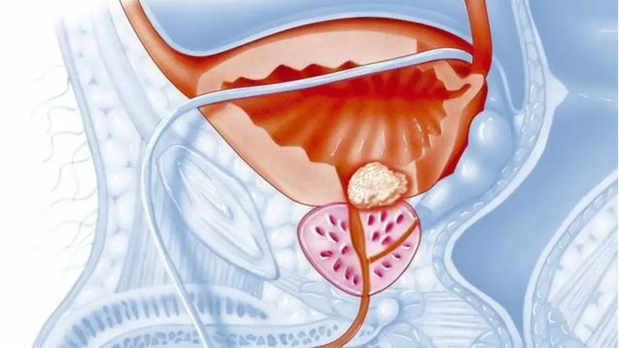 vyrų prostatos liga